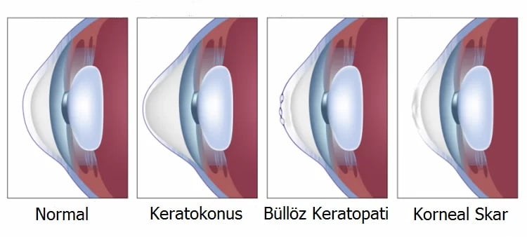 cornea 