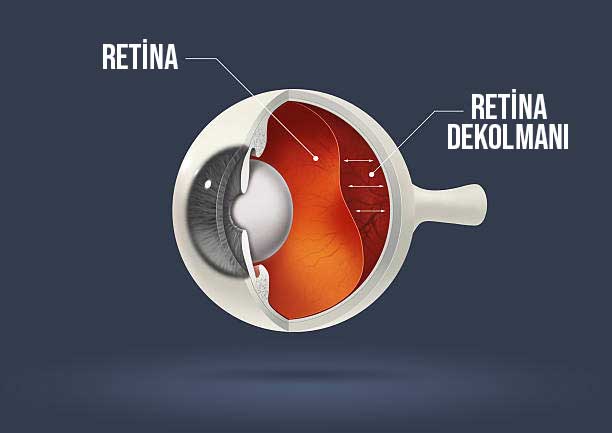 retina-dekolmani